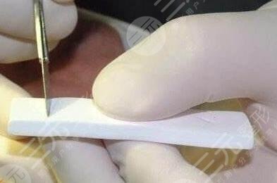 膨体隆鼻如何护理?