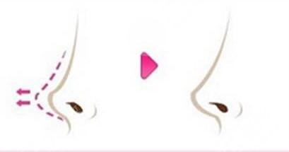 膨体隆鼻如何护理?