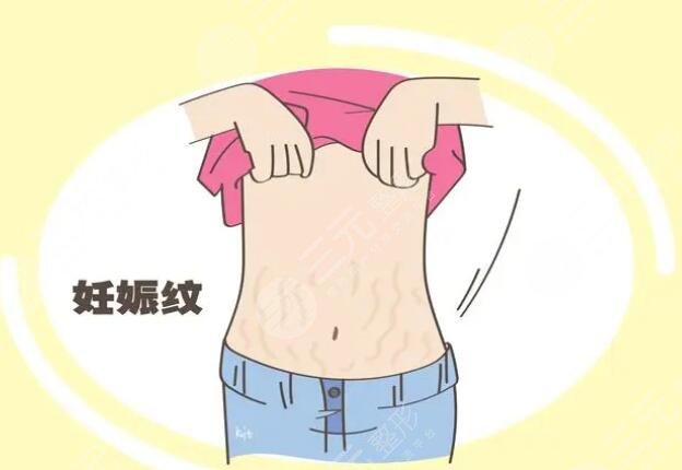 橄榄油去除妊娠纹需要配合使用身体乳嘛？使用方法