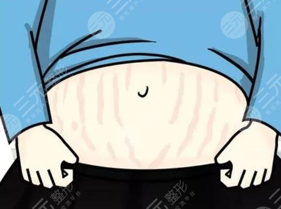 5个妙招帮助消除妊娠纹