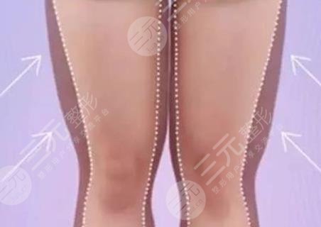 广州韩妃大腿吸脂案例