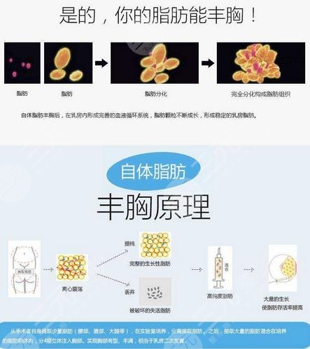 自体脂肪隆胸