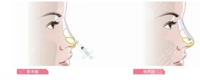 玻尿酸隆鼻价格是多少