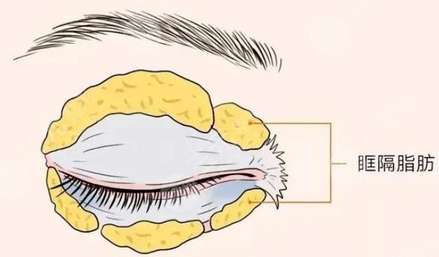 抽脂去眼袋会反弹吗