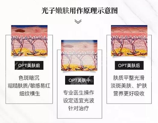 光子嫩肤适合人群多大年龄?