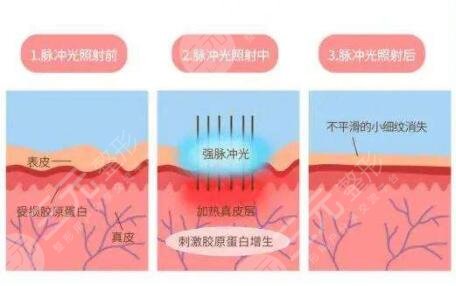 光子嫩肤大概多少钱一次?