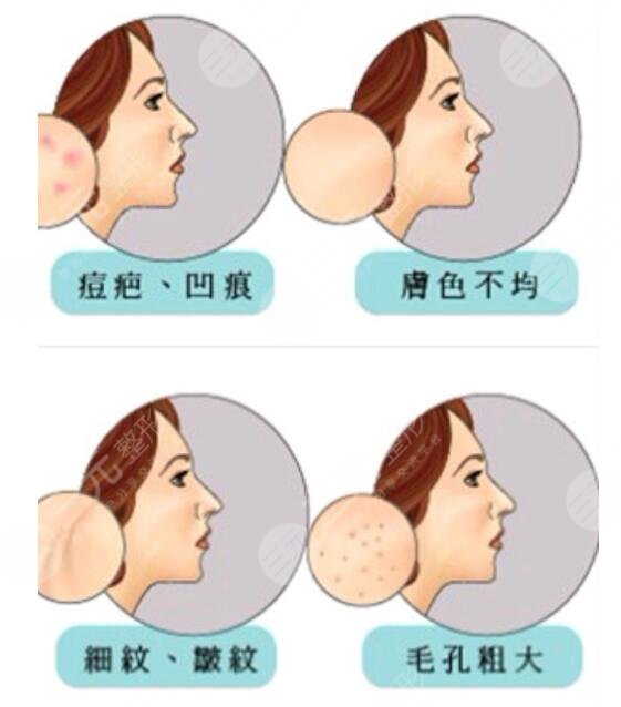 光子嫩肤术后怎样去护理?