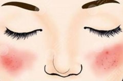 激光去红血丝会反弹吗？产生原因有这几点，你中招了吗