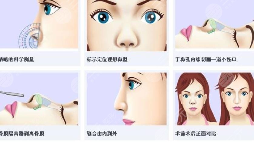 上海伯思立美容医院假体隆鼻案例