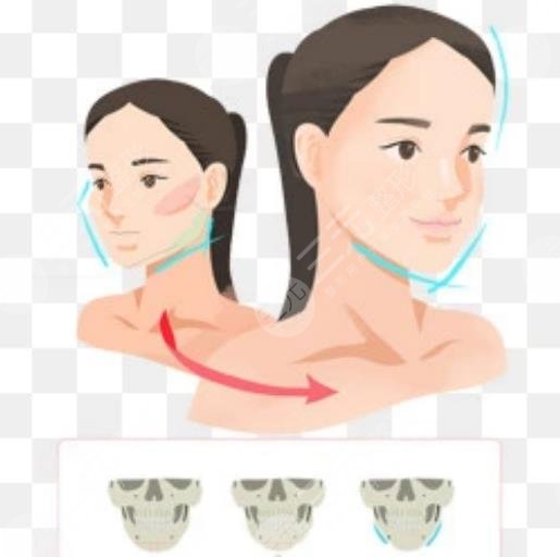 磨骨瘦脸多少费用