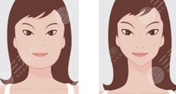 磨骨瘦脸多少费用