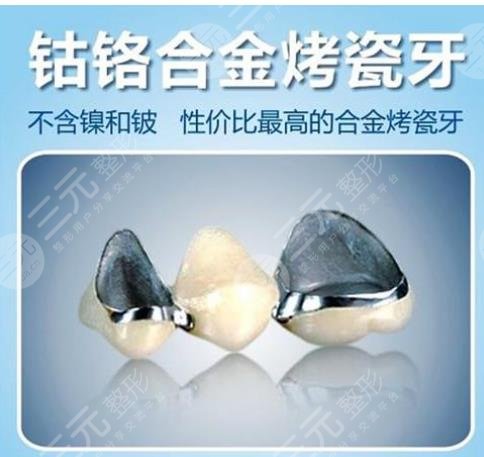 钴铬瓷牙齿