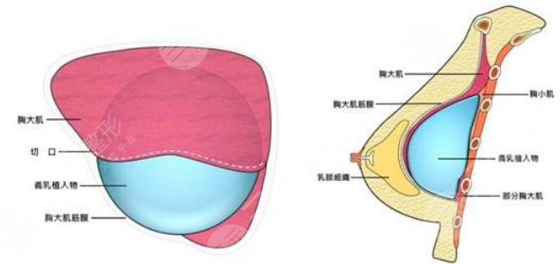 娜绮丽假体隆胸