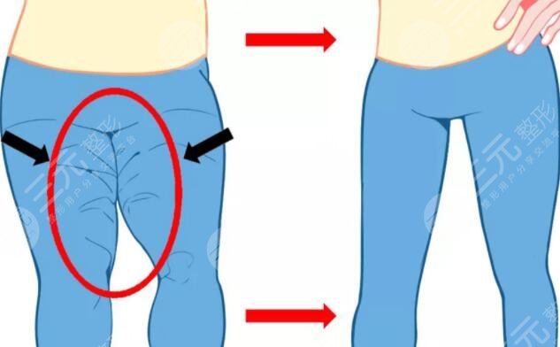 光纤溶脂术后护理方法有哪些?