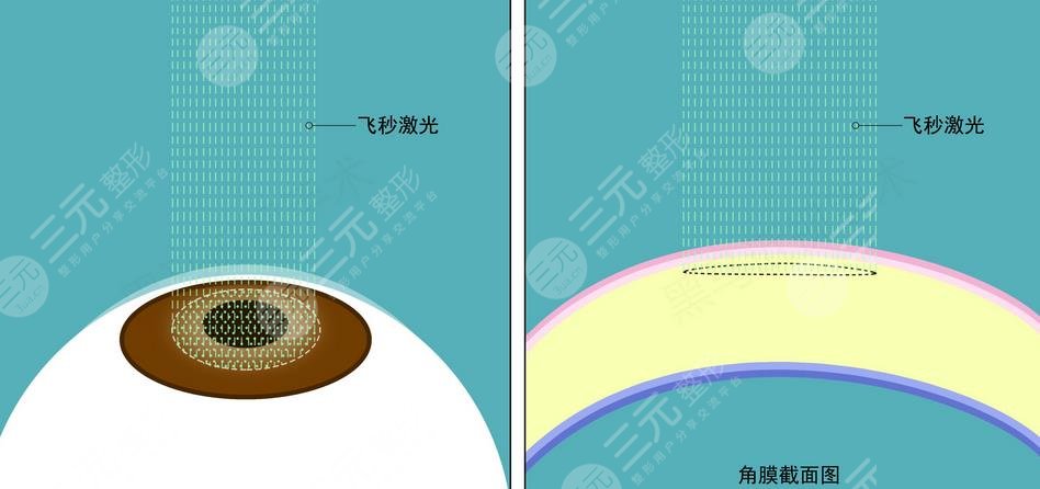 近视眼矫正的方法有哪些