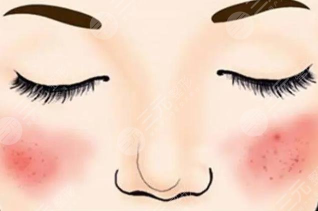 红血丝激光多少钱