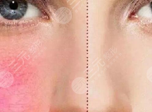 红血丝激光多少钱