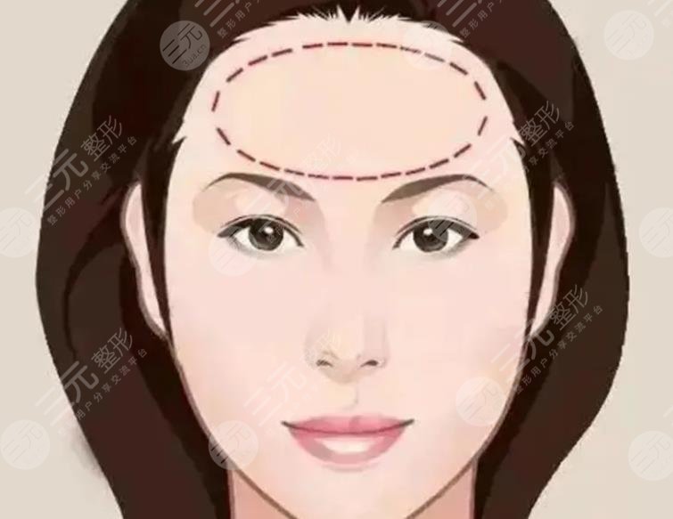 额头窄丰额头价格是多少