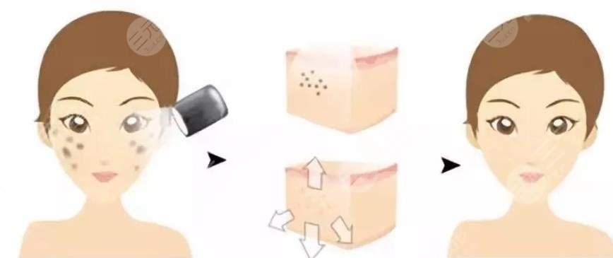 复合彩光缓解多少钱