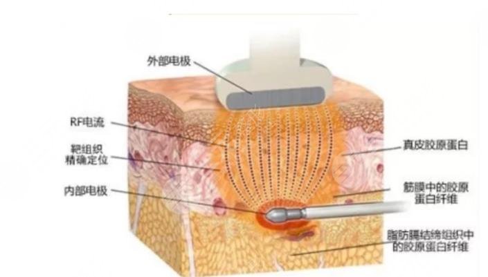 复合彩光缓解多少钱