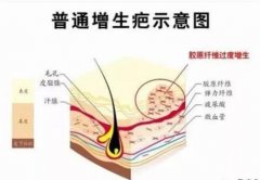 有伤疤怎么去掉？疤痕修复4种方案分享，无惧瑕疵！