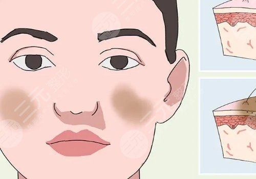 激光祛斑后反黑怎样能快速消除？