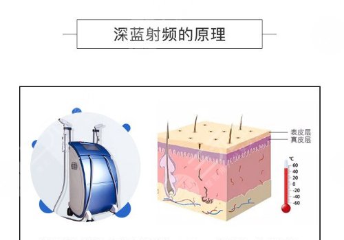 深蓝射频间隔多久做一次？