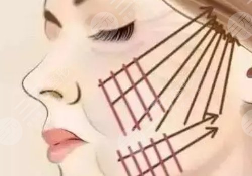 张林宏高一生做拉皮手术怎样?