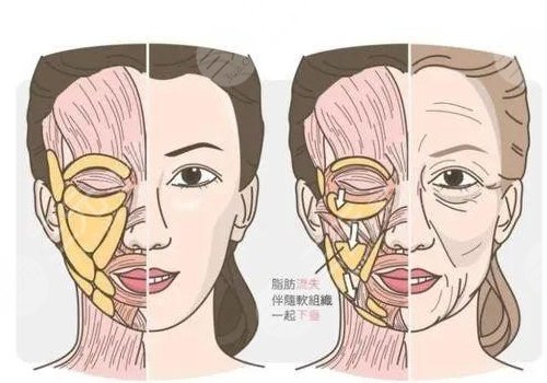 热玛吉是单频还是双频?
