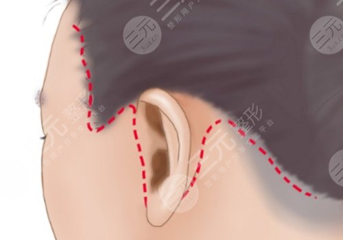 北京黄寺医疗美容诊所做拉皮手术好吗?