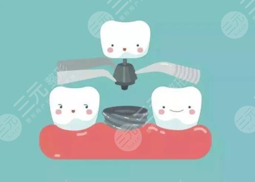 种植牙的使用寿命有多久？平均5-15年使用无虞！