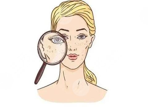 激光祛斑术后注意事项有哪些?