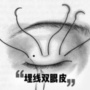 埋线双眼皮手术过程图解！美眼不简单，带你深入了解！