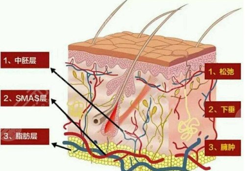 深蓝射频和热拉提的区别