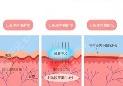 深蓝射频和热拉提的区别