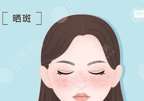 晒斑如何淡化或去掉？