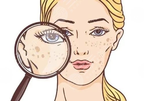 晒斑如何淡化或去掉？