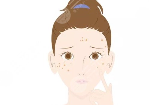 晒斑如何淡化或去掉？