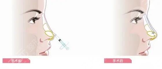 玻尿酸隆鼻可以维持多久时间?