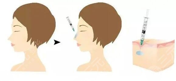 玻尿酸隆鼻有副作用和危害吗?