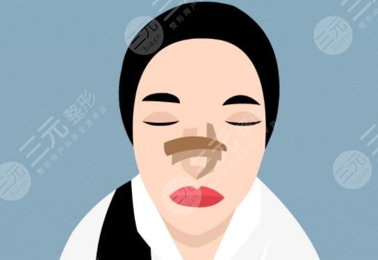 自体软骨隆鼻好吗有效果吗？材料优势/价格多少钱/注意事项