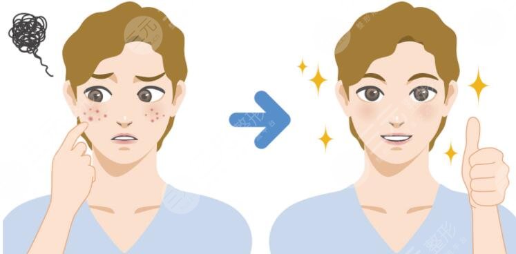 男生祛痘的小窍门是什么?
