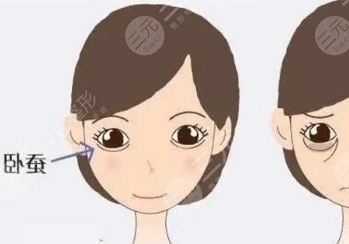 注射卧蚕几天消肿？