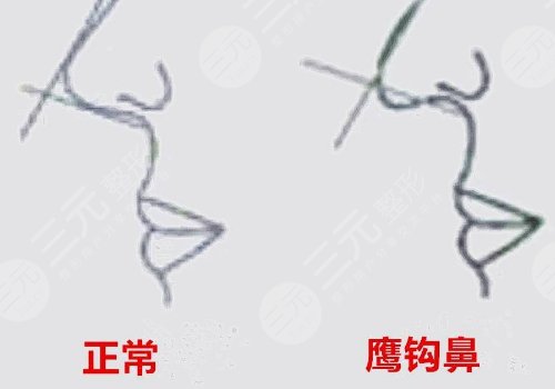 海鸥线和鹰钩鼻的区别