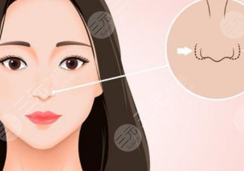 海鸥线和鹰钩鼻的区别