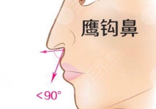 海鸥线和鹰钩鼻的区别