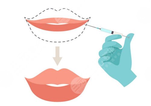 唇部注射玻尿酸需要注意什么？