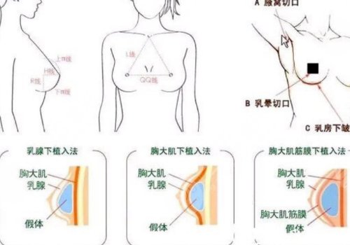 隆胸乳晕切口的优缺点