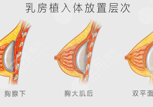 假体隆胸哪个切口好？
