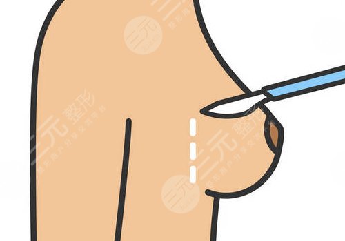 假体隆胸哪个切口好？恢